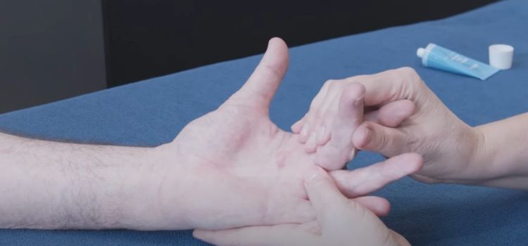 How to Stretch Your Way Out of Dupuytren Contracture: A Guide for Hand Mobility
