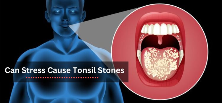 Can Stress Cause Tonsil Stones? Understanding the Connection