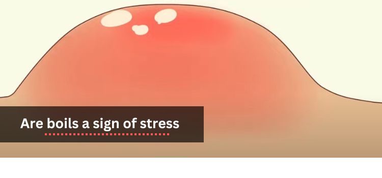 The Link Between Stress and Boils Causes and Prevention.