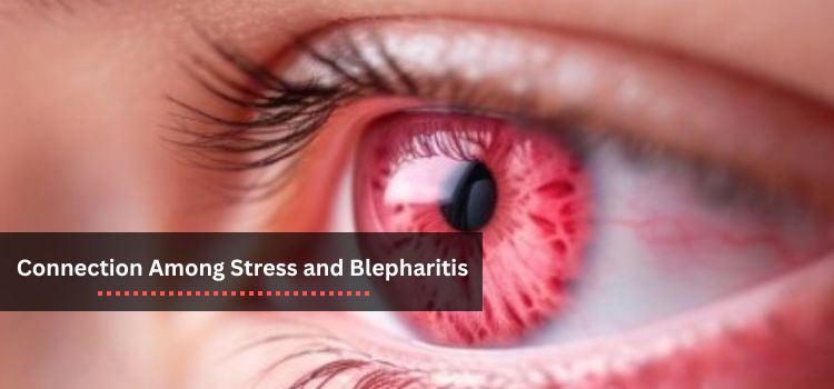 Unraveling the Intricate Link Between Stress and Blepharitis: A Comprehensive Exploration